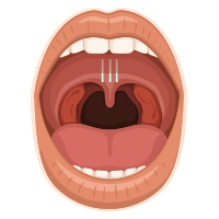 Animated inside of mouth for pillar procedure