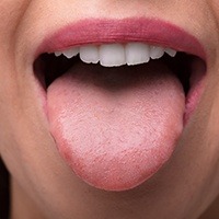 Person in need of tongue reduction sticking out tongue