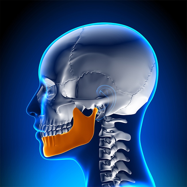 3 D rendering of profile in need of upper and lower jaw surgery