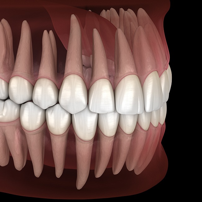 Animated smile after jaw surgery procedure
