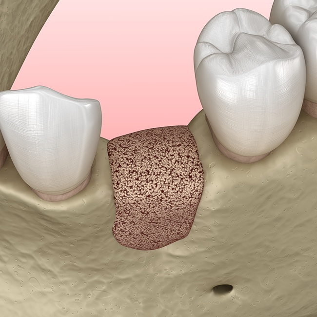 Animated smile after engineer tissue and bone grafting
