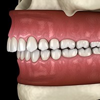 Animated smile in need of occlusal bite correction