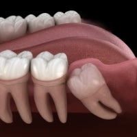 Smile impacted wisdom tooth