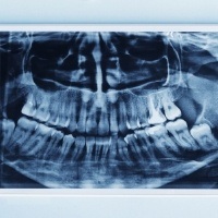 X-ray of smile with pathological cysts and tumors
