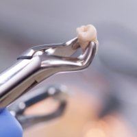 Metal clasp holding extracted wisdom tooth