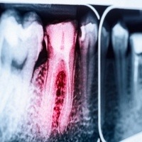 X-ray with infected tooth highlighted red