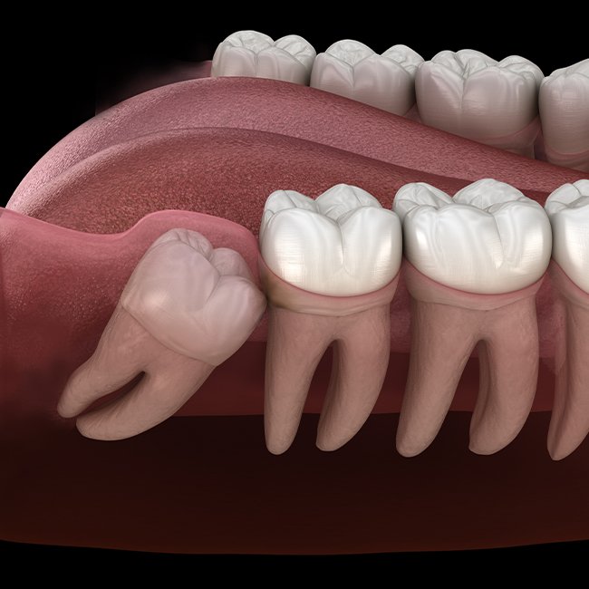 X-ray of smile in need of coronectomy