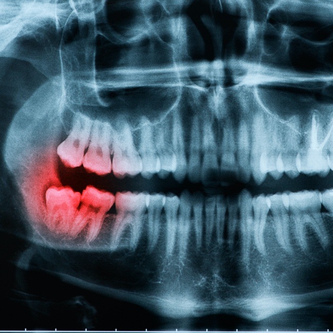 X-ray of smile with impacted wisdom tooth