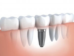 We offer the best dental implants around.