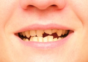 Broken teeth in need of an oral and maxillofacial surgeon