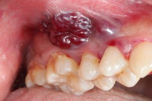 oral cancer