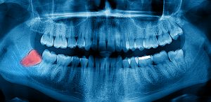 X-ray showing wisdom tooth that should be removed by oral surgeon in Houston