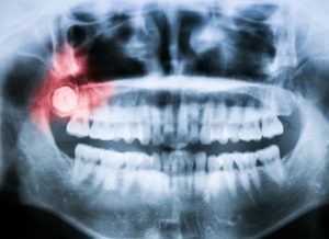 Oral surgeon in houston discusses tooth crowding and wisdom teeth