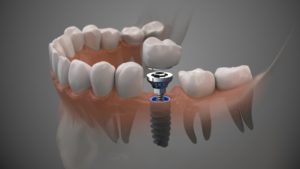 Illustration of implant, abutment, and crown being placed in jaw