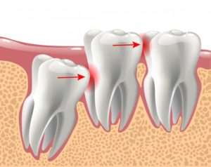 Illustration of mouth in need of wisdom teeth removal