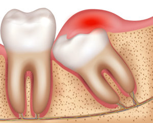 Illustration of mouth that needs wisdom tooth removal