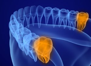 Illustration of lower dental arch with wisdom teeth highlighted in orange