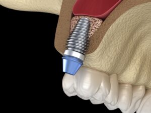 Illustration of dental implant in upper jaw after sinus lift