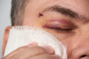 Man holding gauze against his cheek after facial trauma 