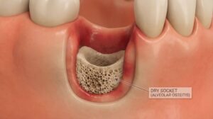 Illustration showing dry socket at site of tooth extraction 