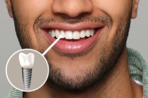 Close-up of a man’s smile with a dental implant