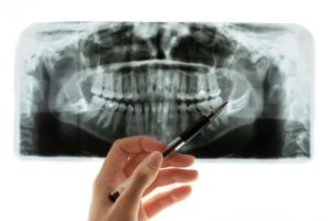 Dentist pointing at sideways wisdom tooth on X-ray 